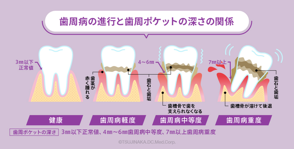 歯周病の進行と歯周ポケットの深さの関係
