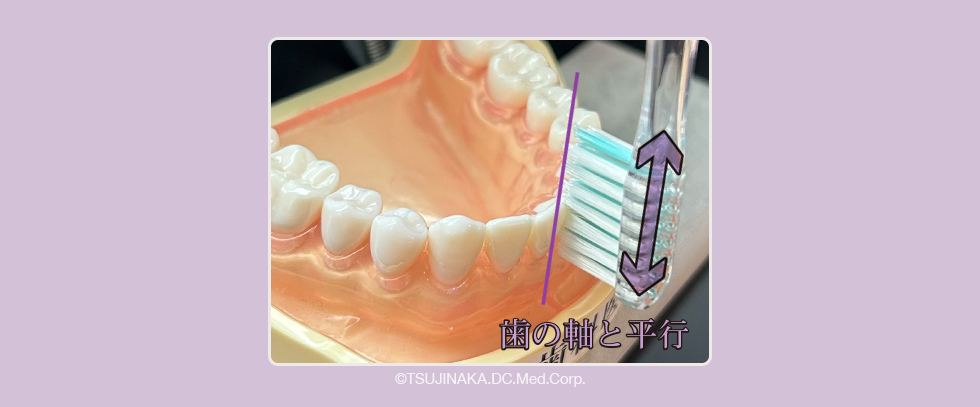歯と歯の間が広い場合