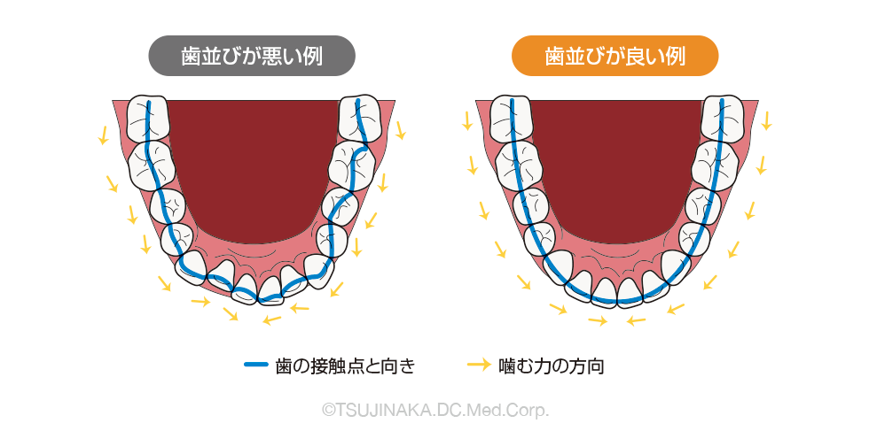 歯並びが悪いとより歯列が不正となる