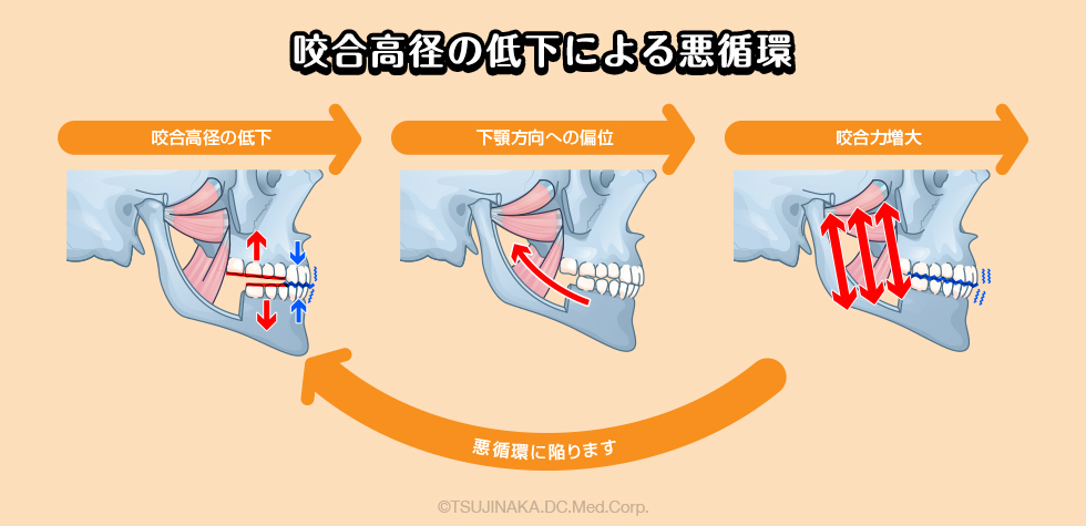 食いしばり(歯ぎしり)」「偏頭痛」「イビキと睡眠時無呼吸症候群」 | 摂津市千里丘でマウスピース矯正・予防歯科ならJR千里丘駅徒歩1分の辻中歯科医院へ