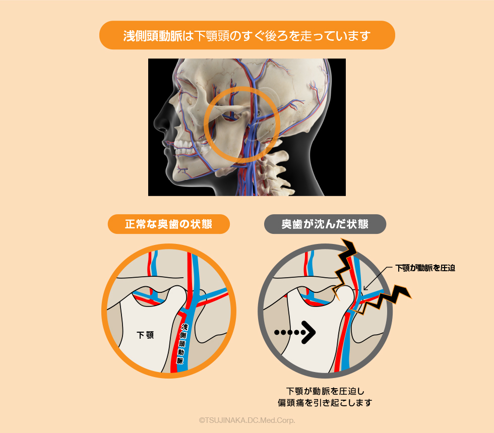 頭の痛み 側頭動脈