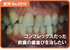 コンプレックスだった前歯の歯並びを治したい