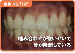 噛み合わせが強いせいで骨が隆起している