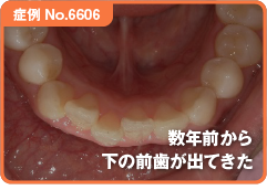 数年前から下の前歯が出てきた