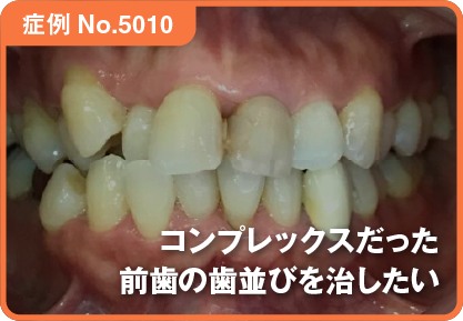 コンプレックスだった前歯の歯並びを治したい
