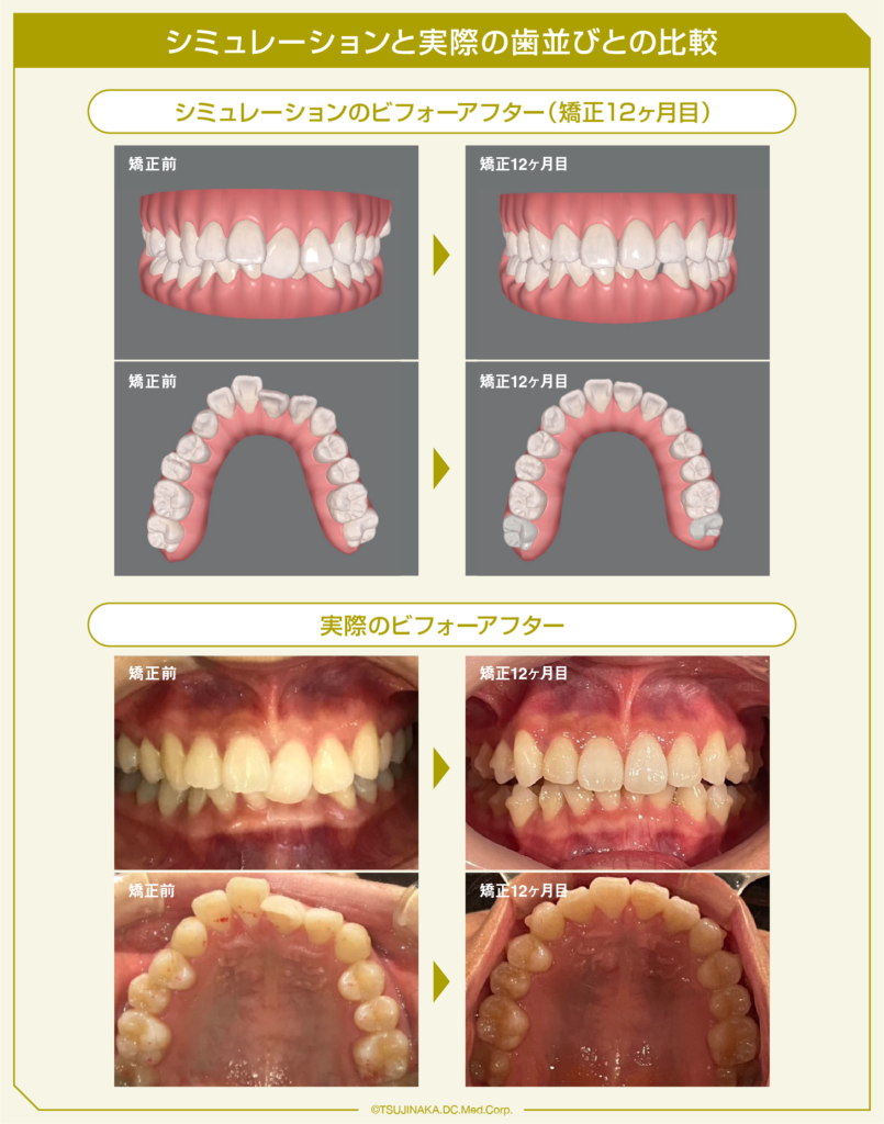 シミュレーションと実際の歯並びとの比較