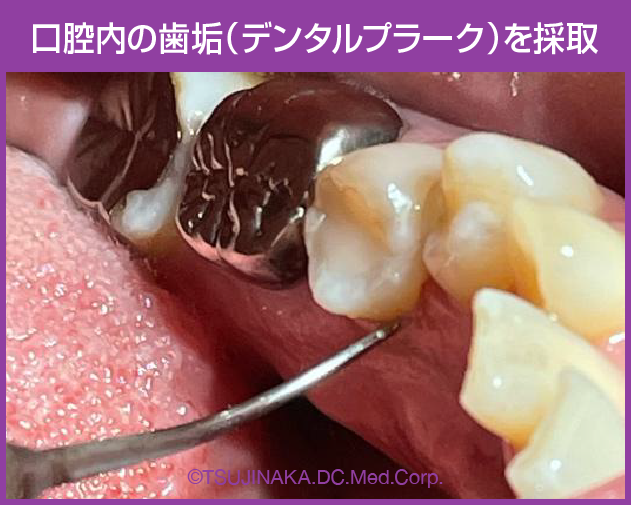 口腔内の歯垢（デンタルプラーク）を採取