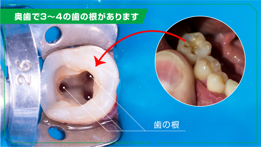 奥歯で3～4の歯の根があります