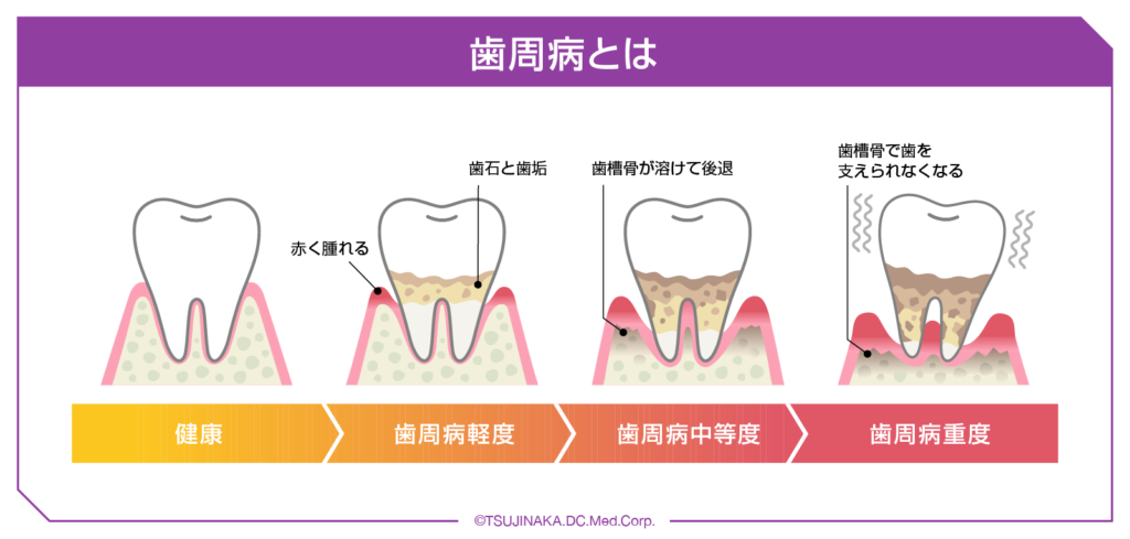 歯周病の進行とその症状