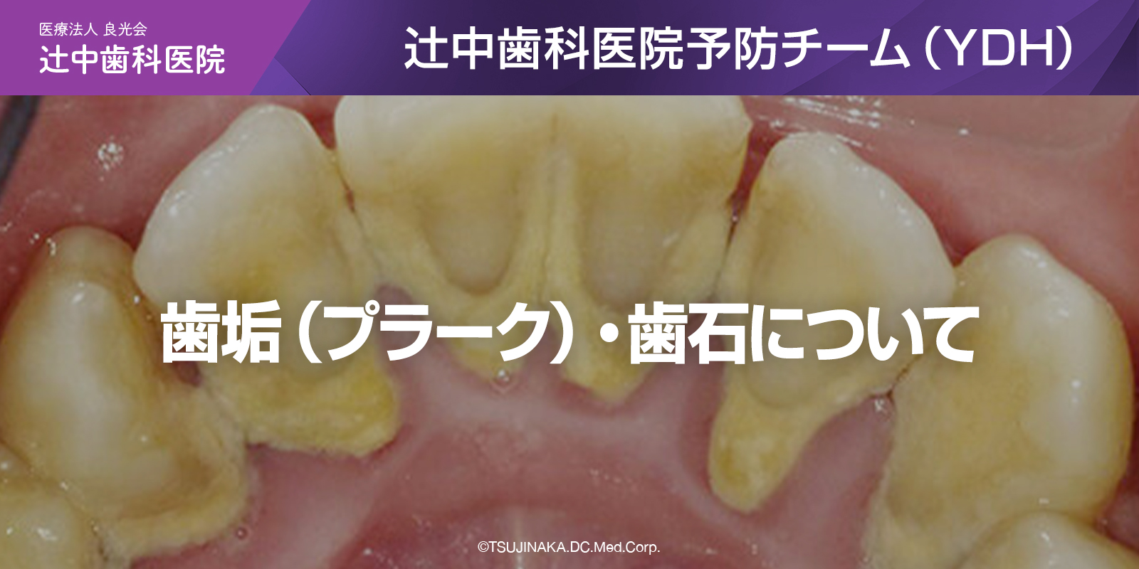 歯垢（プラーク）・歯石について現役衛生士が詳しく解説
