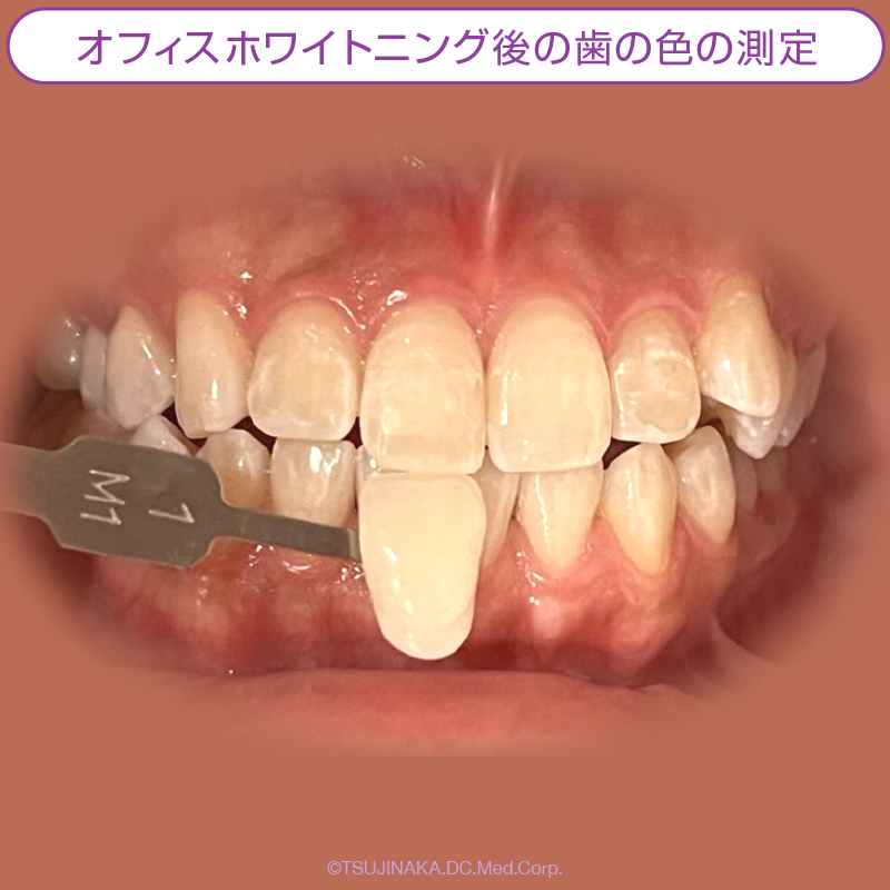 オフィスホワイトニング後の歯の色の測定