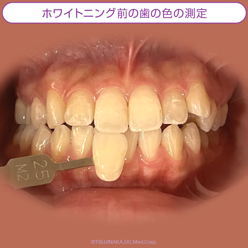 ホワイトニング前の歯の色の測定