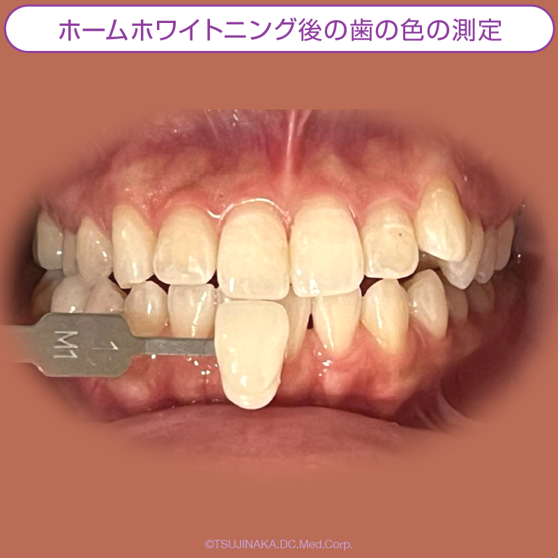 ホームホワイトニング後の歯の色の測定