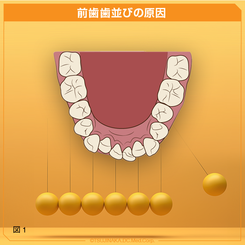 前歯歯並びの原因