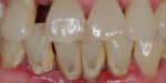 歯周病(歯槽膿漏）の進行と矯正治療での歯が動く仕組みについて