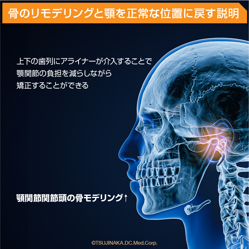 骨のリモデリングと顎を正常な位置に戻す説明