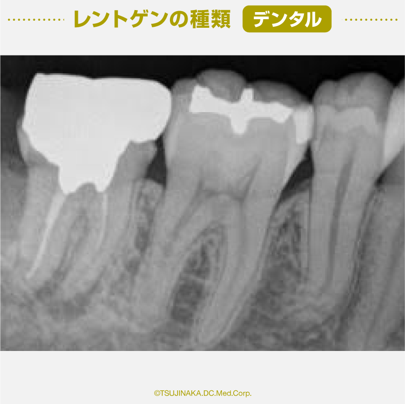 レントゲンの種類 / デンタル