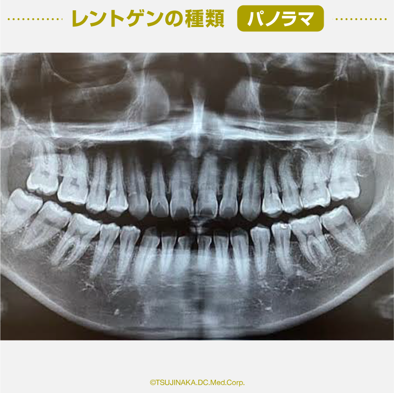 レントゲンの種類 / パノラマ