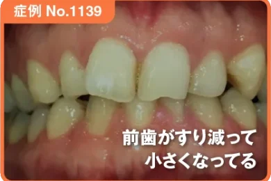 【症例No.1139】 前歯がすり減って小さくなってる