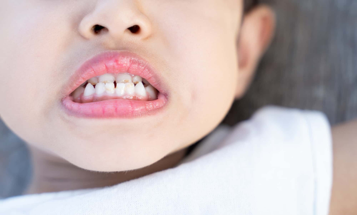 プレオルソが適応となる受け口の子ども