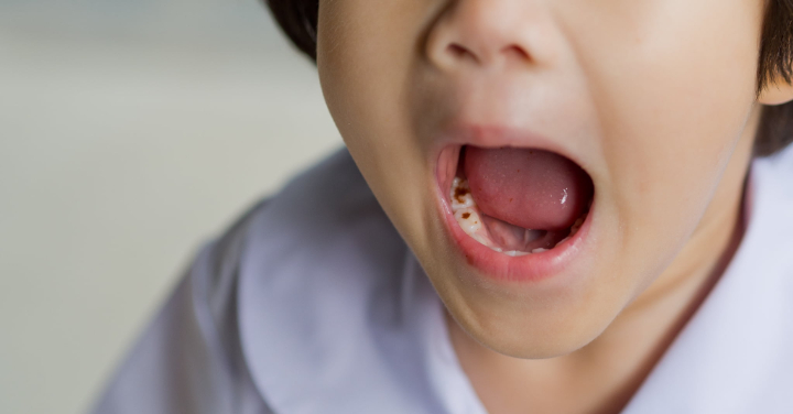 プレオルソ治療中に虫歯になった子ども