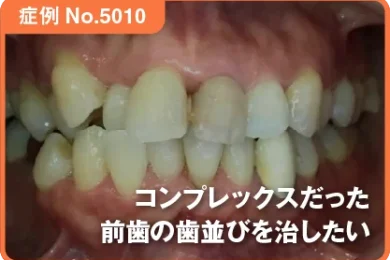 【症例No.5010】 コンプレックスだった前歯の歯並びを治したい