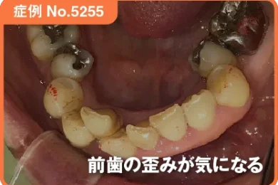 【症例No.5255】前歯の歪みが気になる