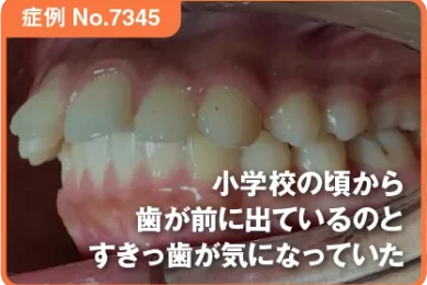【症例No.7345】小学校の頃から歯が前に出ているのとすきっ歯が気になっていた