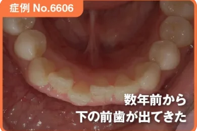 【症例No.6606】数年前から下の前歯が出てきた