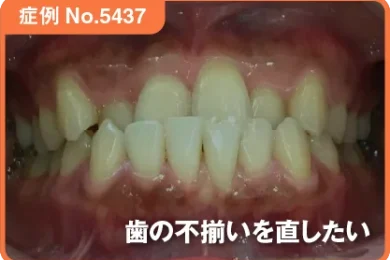 【症例No.5437】歯の不揃いを直したい