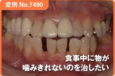 【症例No.7490】食事中に物が噛みきれないのを治したい