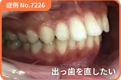 【症例No.7226】 出っ歯をなおしたい