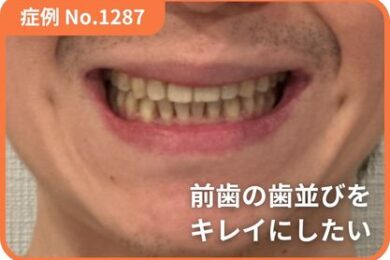 【症例No.1287】 上下のデコボコ（叢生）