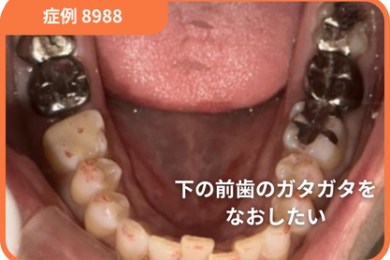 【症例No.8988】下の前歯のガタガタをなおしたい