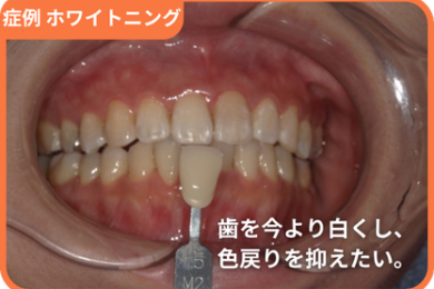 症例　ホワイトニング